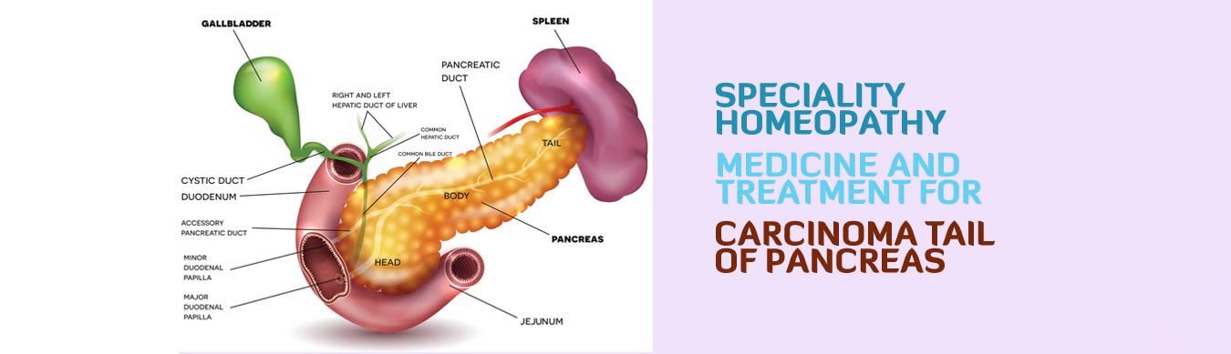 Carcinoma tail of Pancreas